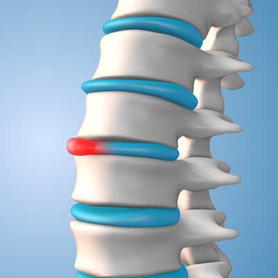 Bulging Disc