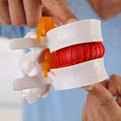 advantages of non-surgical spinal decompression